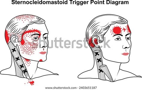 Sternocleidomastoid Trigger Point Vector Diagram Stock Vector Royalty