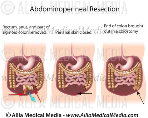 Abdominoperineal Resection Alila Medical Images
