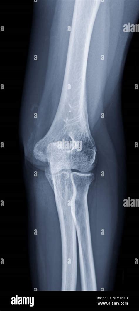 X Ray Of Elbow Join Showing Normal Elbow Joint Stock Photo Alamy