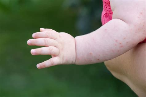 Cara Mengatasi Alergi Kulit Bintik Merah Pada Bayi Jack Davies