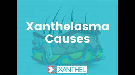 Xanthelasma Causes What Are The Cause Of Xanthelasma And Xanthomas