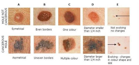Cancerous Moles Signs Types Pictures Cancerous Mole On The Back Neck