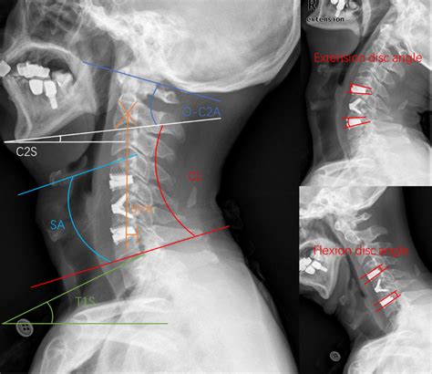 Schematic Diagram Of The Parameters X Rays Show Several Cervical