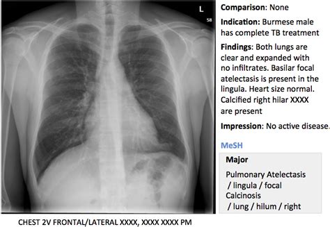 An Example Of Openi 2 Chest X Ray Image Report And Annotations