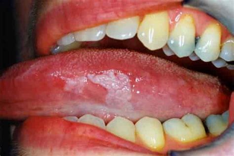 Have white patches on your tongue. White Spots on Tongue, Tip, Side, Under, Back, Dots ...