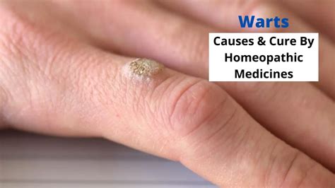 Homeopathy For Warts Causes Symptoms Cure And Medicines