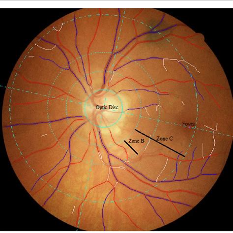 Optic Disc Centred Retinal Fundus Image Assessed Using The Vessel