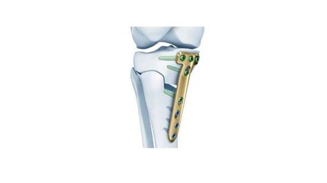 Tomofix® Medial High Tibia Plate Depuy Synthes