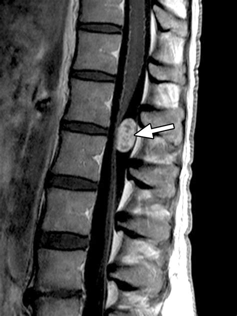 Intradural Extramedullary Spinal Neoplasms Radiologic Pathologic