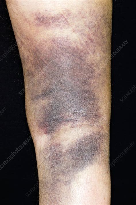 Bruising Of The Leg After A Fall Stock Image C0029690 Science