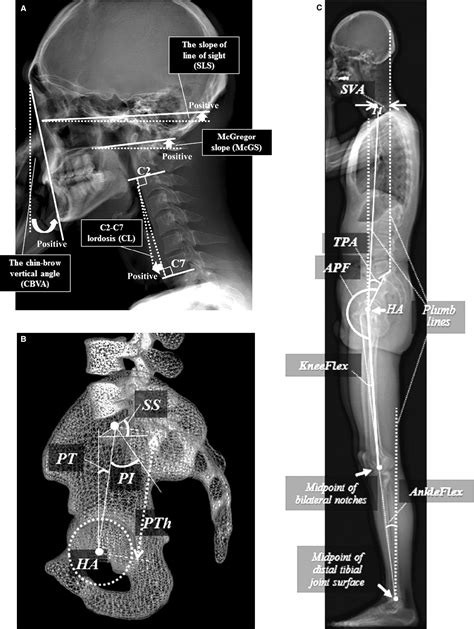 Standing Sagittal Alignment Of The Whole Axial Skeleton With Reference