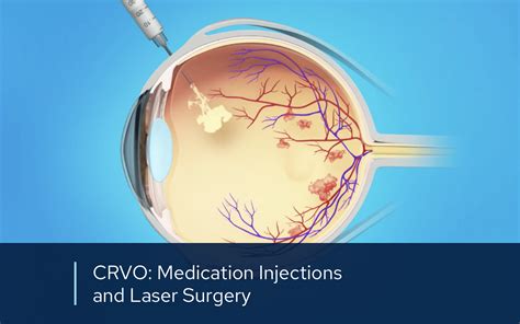 Laser Retina Surgery Retinal Consultants Medical Group