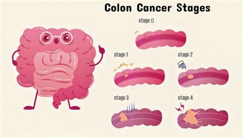 Colon Cancer Early Warning Signs And Stages Of Colon Cancer Page 11 Of 16 Healthella