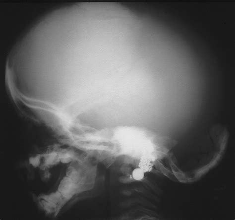 The Infant Skull A Vault Of Information Radiographics