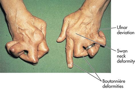 15 Arthritis Center Of Idaho Hand Deformities Of Rheumatoid
