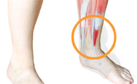 Anterior Tibialis Tendonitis And How To Treat It Otosection