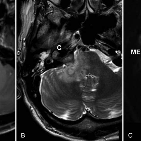 Preoperative Mr Imaging A T1 Weighted Gadolinium Enhanced Axial Mr