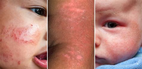 Baby Eczema Atopic Dermatitis On Your Infant Symptoms And Treatment