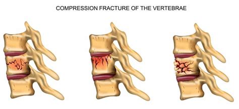 Spinal Fractures Types Causes Symptoms Diagnosis And Treatments My