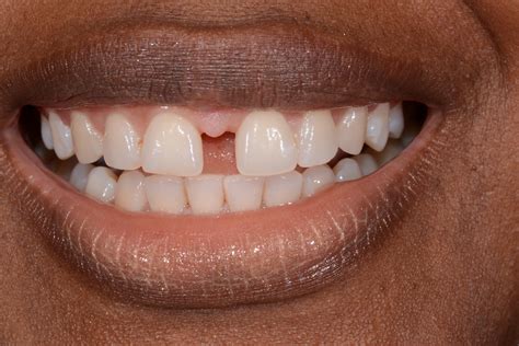 As time went on i looked into a lot of expensive fixes. How To Close A Space Between Teeth - TeethWalls