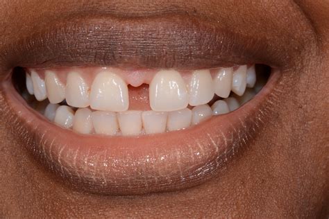 Close the gap for any missing teeth. How To Close A Space Between Teeth - TeethWalls