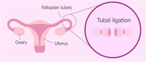 Is It Possible To Reverse Tubal Ligation