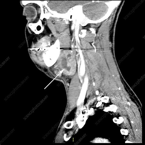 Submandibular Gland Abscess CT Scan Stock Image C Science Photo Library