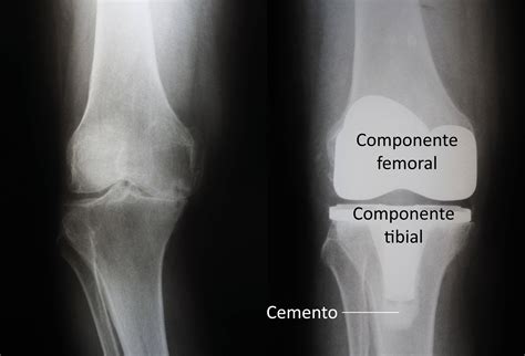Reemplazo Total De Rodilla Total Knee Replacement Orthoinfo Aaos