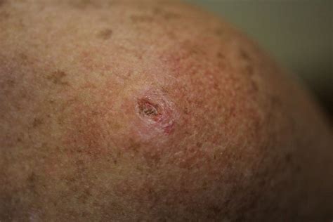 What Does Skin Cancer Look Like Beauty Beauty World News
