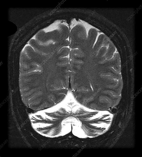 Severe Cerebellar Atrophy Stock Image C0435511 Science Photo Library