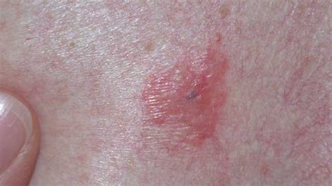 Symptoms Of Skin Cancer On Upper Leg