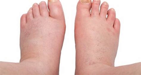Swollen Feet Causes Treatment For It
