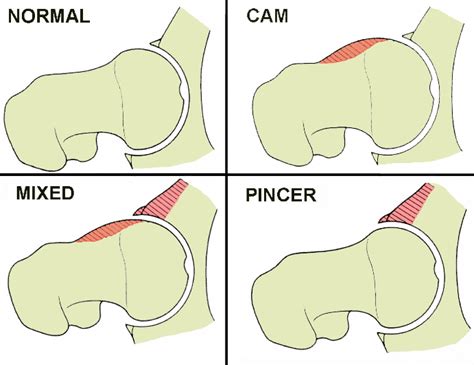 What Is Femoroacetabular Impingement And What Causes It