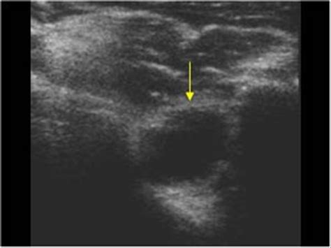 Synovial Cyst Shoulder