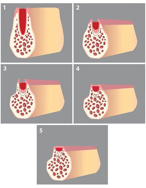 Figure 1 The Five Stages Of Extraction Socket Healing Alveolar Bone