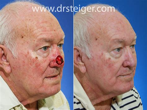 Mohs Surgery And Forehead Flap Nose Reconstruction