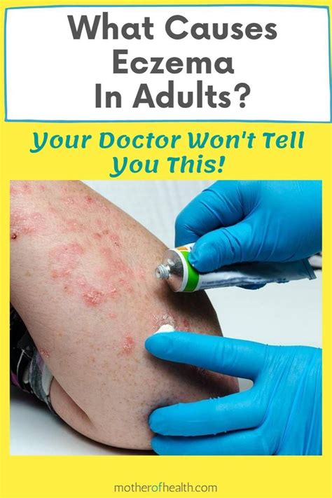 What Causes Eczema In Adults Mother Of Health Eczema Remedies