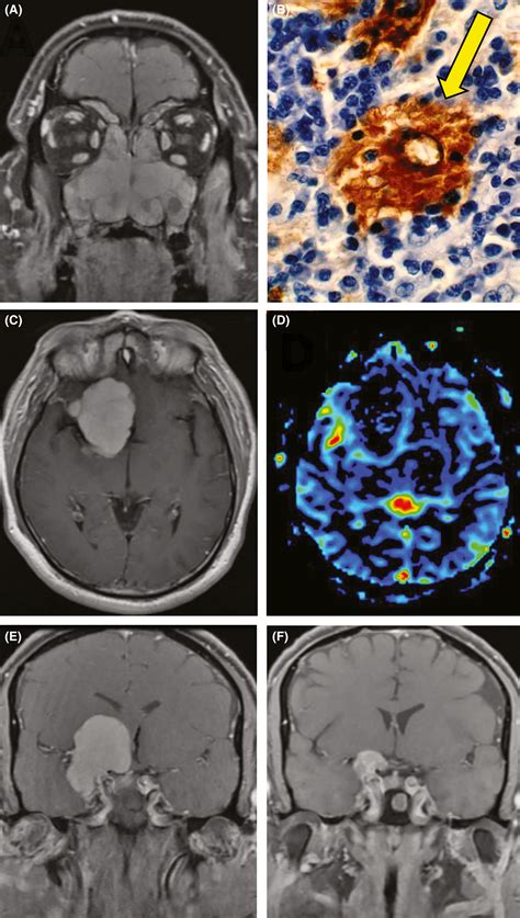 Differentiation Of Intracranial Rosai‐dorfman Histiocytosis From