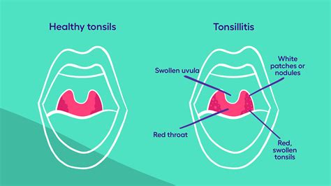 What Is Tonsillitis Your Guide To Symptoms And Treatment