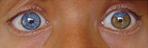 Complete Heterochromia Of Iris Of Right Eye And Partial Heterochromia