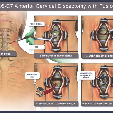 C6 C7 Anterior Cervical Discectomy With Fusion Trialexhibits Inc