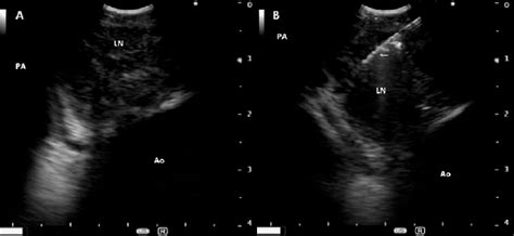 A Endobronchial Ultrasound Showing Enlarged Precarinal Lymph Node