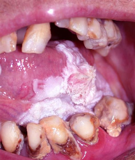Leukoplakia — the damage of a mucous membrane which is shown a focal orogoveniye of a multilayered flat epithelium. Oral Leukoplakia