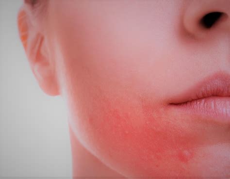 Rosacea And Redness Coastal Valley Dermatology