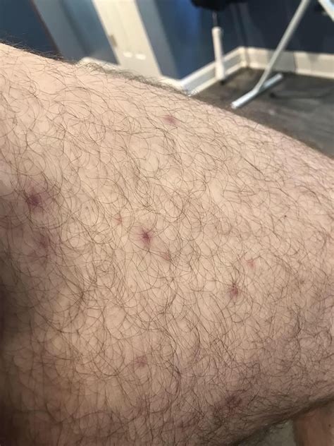 Any Idea About These Bumps On My Inner Thighs And Arms R