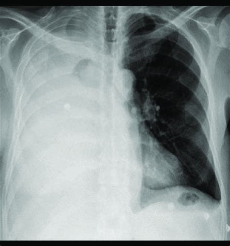 Re Admission Chest X Ray 1 Month After Surgery Showing Right Download Scientific Diagram