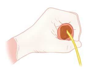 How To MASTER The Foley Catheter Insertion Advanced Tips Tricks