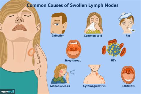View Swollen Lymph Nodes Neck Cancer Symptoms  Cancer Diagnosis