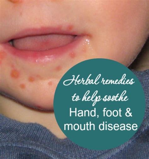 Herbs For Hand Foot And Mouth Disease Hand Foot And Mouth Natural