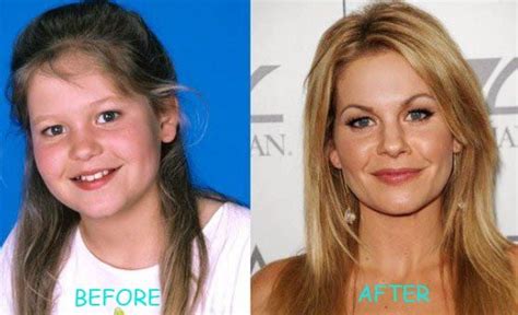 Candace Cameron Plastic Surgery Before And After Nose Job Nose Job